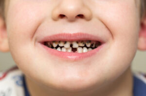 Early Childhood Cavities: Prevention and Treatment Options